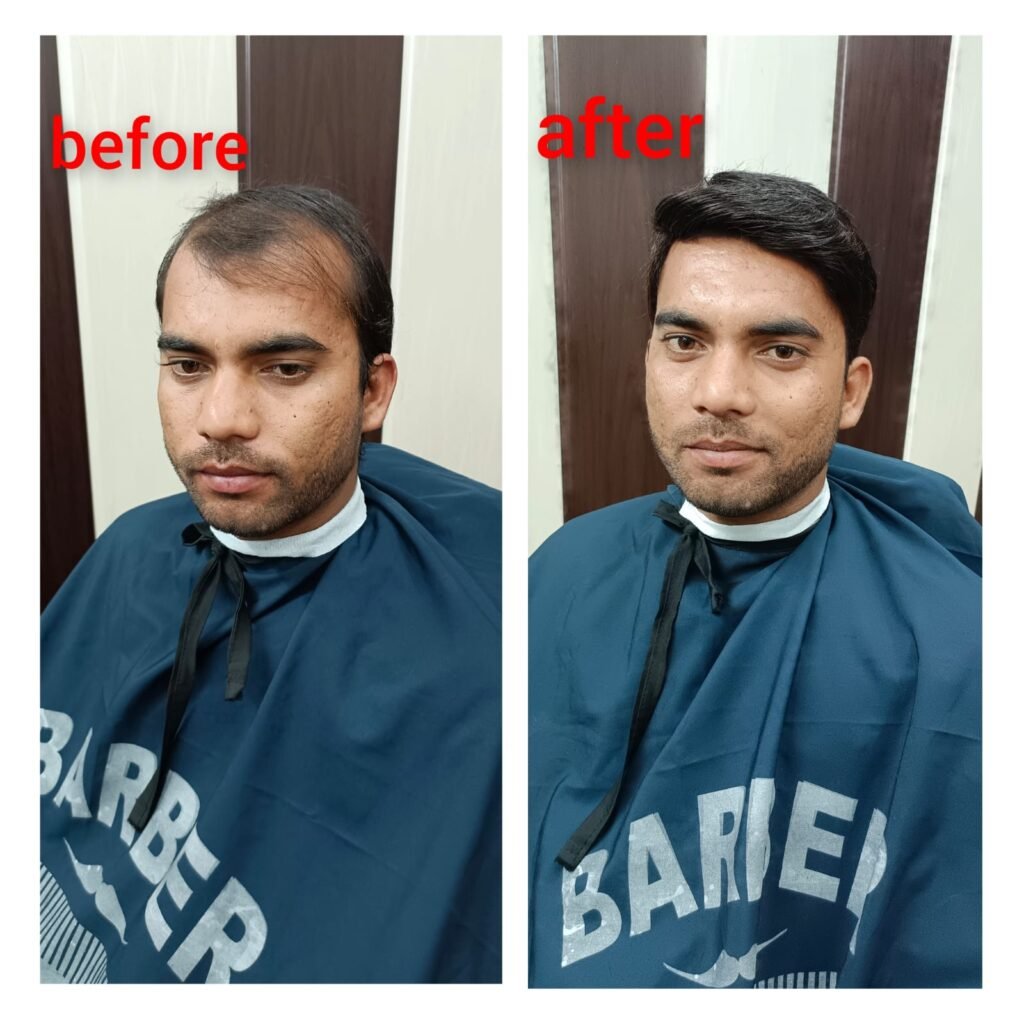 Non-Surgical Hair Fixing In Ghaziabad