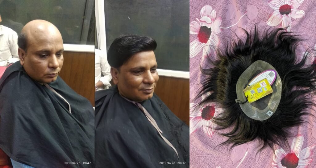 Best Hair Toupee Services In Ghaziabad