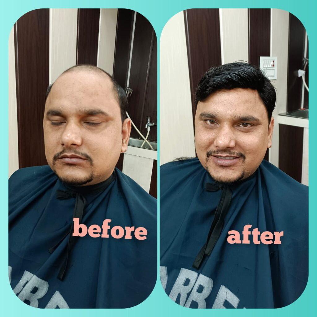 Hair Toupee In Ghaziabad: A Comprehensive Guide to Hair Restoration